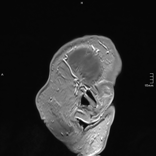 Neurosarcoidosis - involvement of the mesial temporal lobes (Radiopaedia 67429-76820 Sagittal T1 C+ 9).jpg
