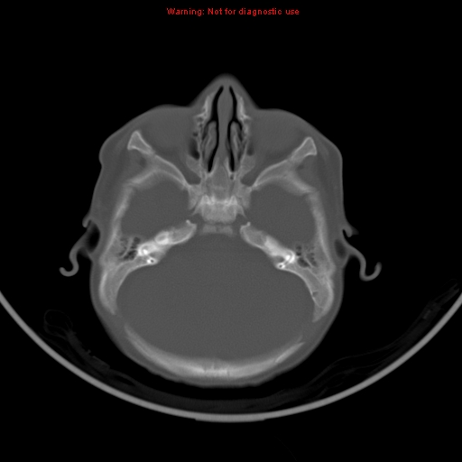 File:Non-accidental injury - bilateral subdural with acute blood (Radiopaedia 10236-10765 Axial bone window 6).jpg