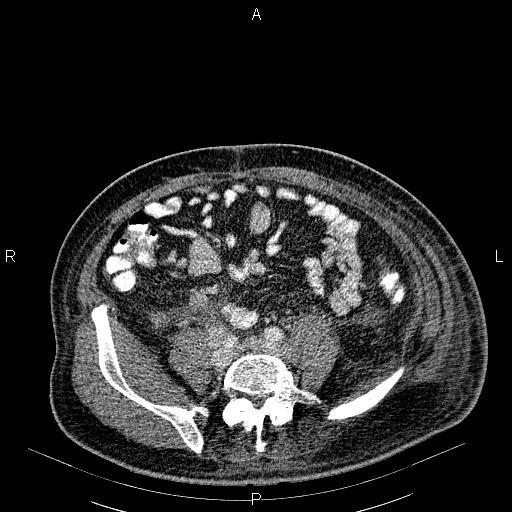 File:Non Hodgkin lymphoma in a patient with ankylosing spondylitis (Radiopaedia 84323-99621 B 49).jpg