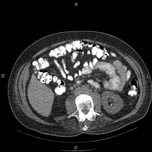 File:Non Hodgkin lymphoma in a patient with ankylosing spondylitis (Radiopaedia 84323-99624 Axial non-contrast 43).jpg