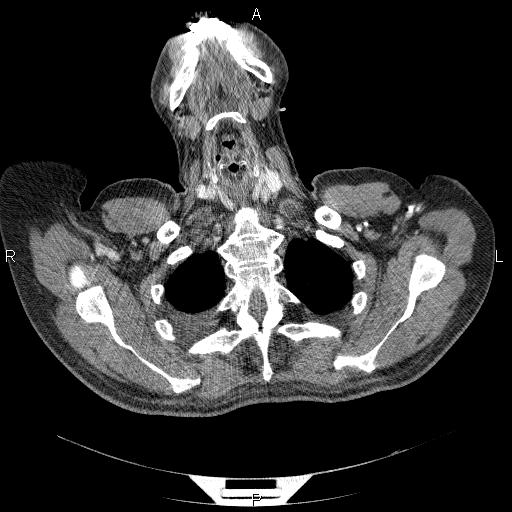 File:Non Hodgkin lymphoma in a patient with ankylosing spondylitis (Radiopaedia 84323-99624 B 4).jpg