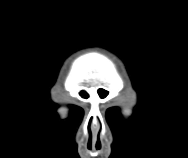 File:Normal CTA head (Radiopaedia 40801-43464 B 8).png
