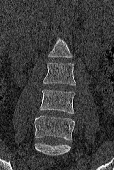 Normal CT lumbar spine (Radiopaedia 53981-60118 Coronal bone window 18).jpg