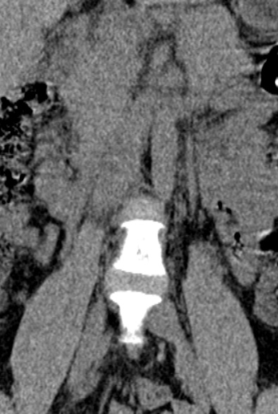 Normal CT lumbar spine (Radiopaedia 53981-60118 F 5).jpg