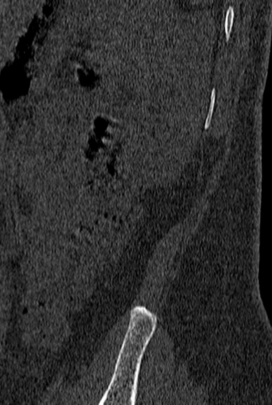 File:Normal CT lumbar spine (Radiopaedia 53981-60118 Sagittal bone window 105).jpg