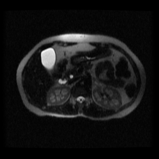 File:Normal MRCP (Radiopaedia 41966-44978 Axial T2 thins 16).png