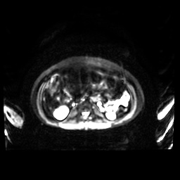 Normal MRI abdomen in pregnancy (Radiopaedia 88001-104541 Axial DWI 29).jpg