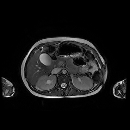 File:Normal MRI abdomen in pregnancy (Radiopaedia 88001-104541 Axial Gradient Echo 16).jpg