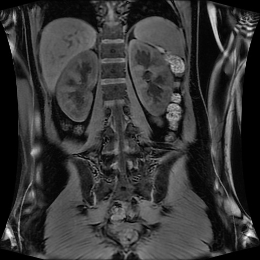 Normal MRI abdomen in pregnancy (Radiopaedia 88001-104541 M 100).jpg