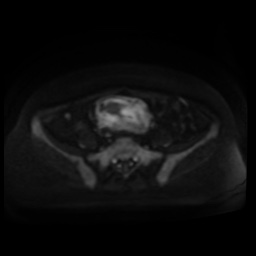Normal MRI abdomen in pregnancy (Radiopaedia 88005-104548 Axial DWI 100).jpg