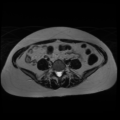 Normal MRI abdomen in pregnancy (Radiopaedia 88005-104548 Axial T2 11).jpg