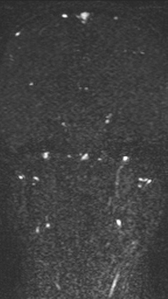 Normal MRI brain with MRV- teenager (Radiopaedia 49425-54553 Coronal MRV 138).jpg