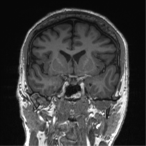 Normal brain MRI (non-focal epilepsy protocol) (Radiopaedia 53917-60040 Coronal T1 42).png
