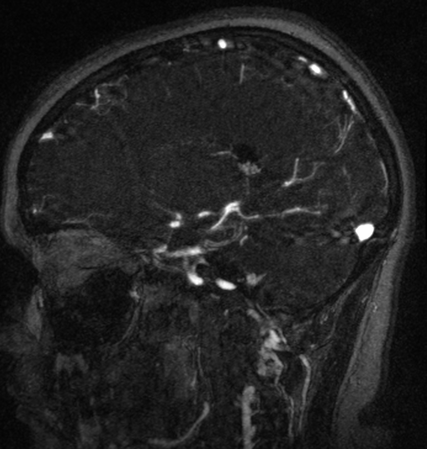 Normal brain MRI and venogram (Radiopaedia 39554-41862 Sagittal MRV 41).jpg