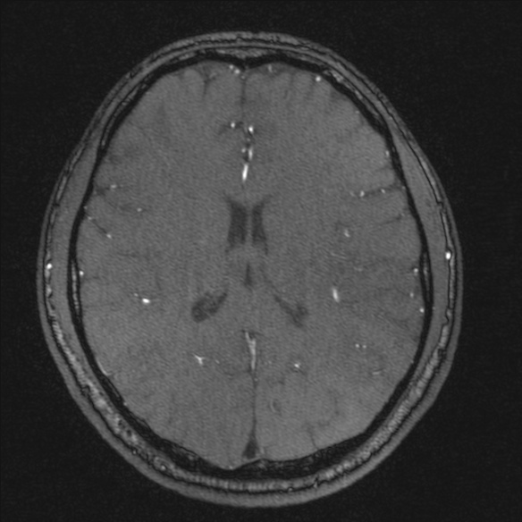 Normal brain MRI including MRA (Radiopaedia 48748-53763 Axial MRA 134).jpg