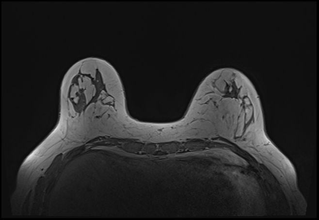 File:Normal breast MRI - dense breasts (Radiopaedia 80454-93850 Axial T1 60).jpg