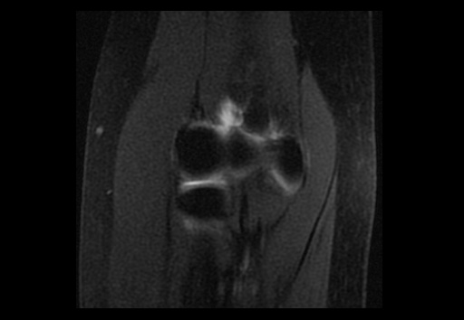 File:Normal elbow arthrograms (Radiopaedia 75550-86805 Coronal T1 fat sat 10).jpg