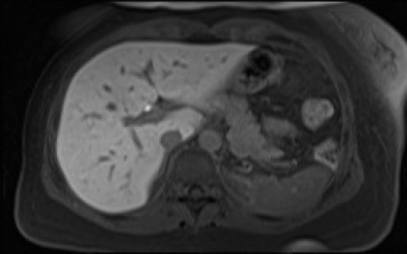 File:Normal hepatobiliary phase liver MRI (Radiopaedia 58968-66230 A 36).jpg