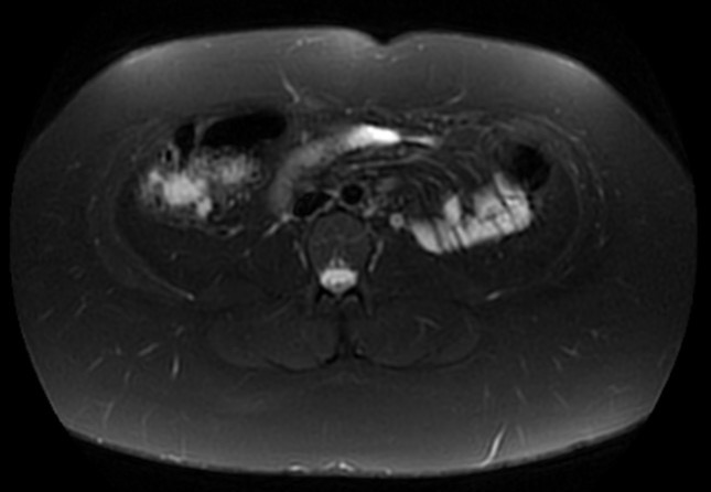 File:Normal liver MRI with Gadolinium (Radiopaedia 58913-66163 Axial T2 fat sat 8).jpg