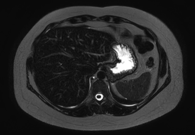 File:Normal liver MRI with Gadolinium (Radiopaedia 58913-66163 E 25).jpg