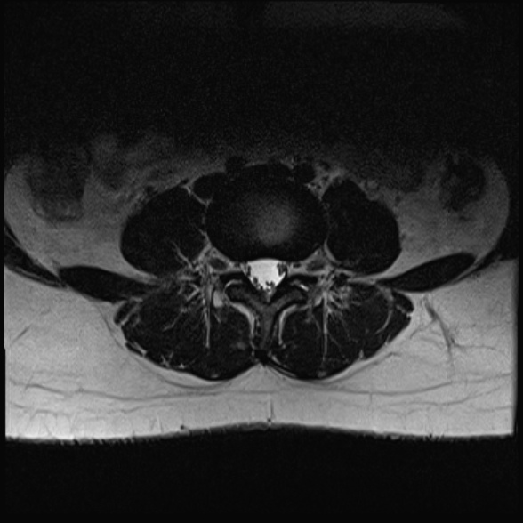 File:Normal lumbar spine MRI- 3 T (Radiopaedia 53280-59250 Axial T2 17).jpg