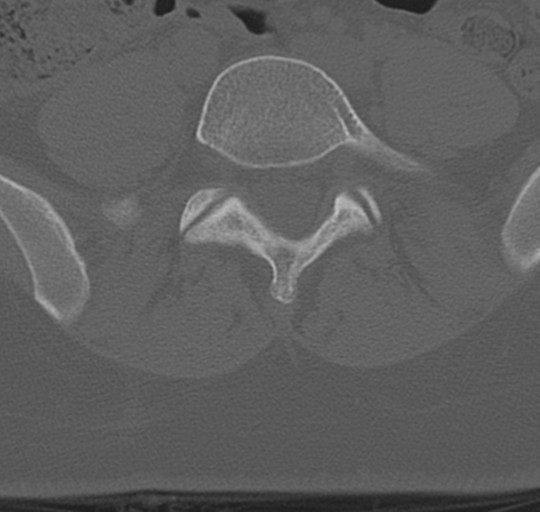 File:Normal lumbosacral CT (Radiopaedia 37923-39867 Axial bone window 75).png