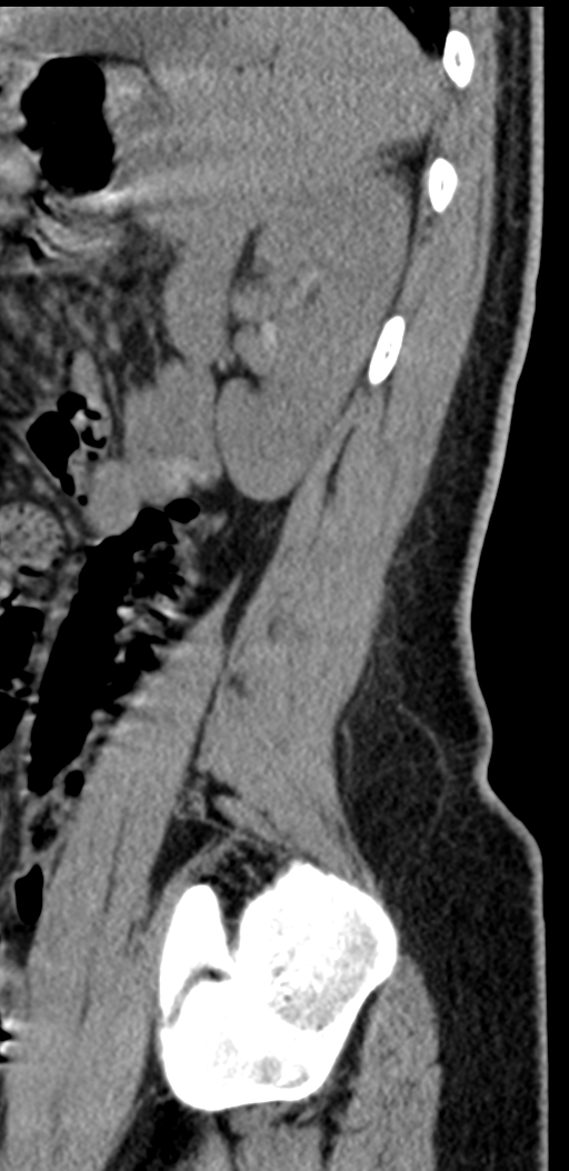 Normal lumbosacral CT (Radiopaedia 37923-39867 E 21).png