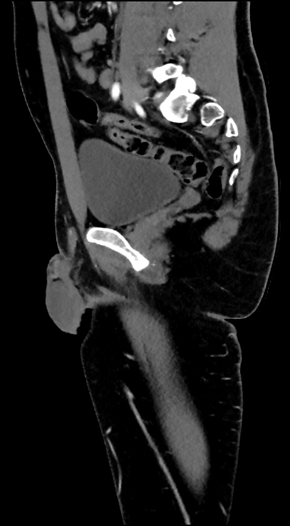 Normal pelvis CT angiogram (Radiopaedia 84966-100481 C 48).jpg