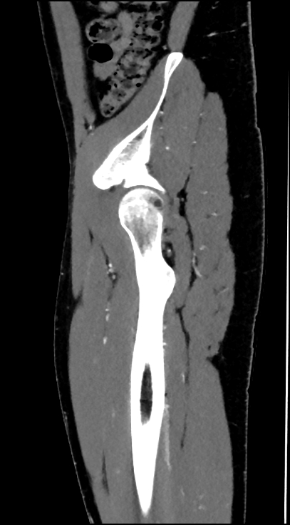 Normal pelvis CT angiogram (Radiopaedia 84966-100481 C 88).jpg