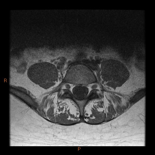 File:Normal spine MRI (Radiopaedia 77323-89408 Axial T1 20).jpg