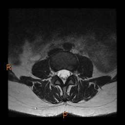 File:Normal spine MRI (Radiopaedia 77323-89408 Axial T2 8).jpg
