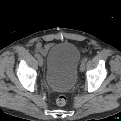 File:Obstructed Tenckhoff peritoneal dialysis catheter (Radiopaedia 37858-39789 Axial non-contrast 9).jpg