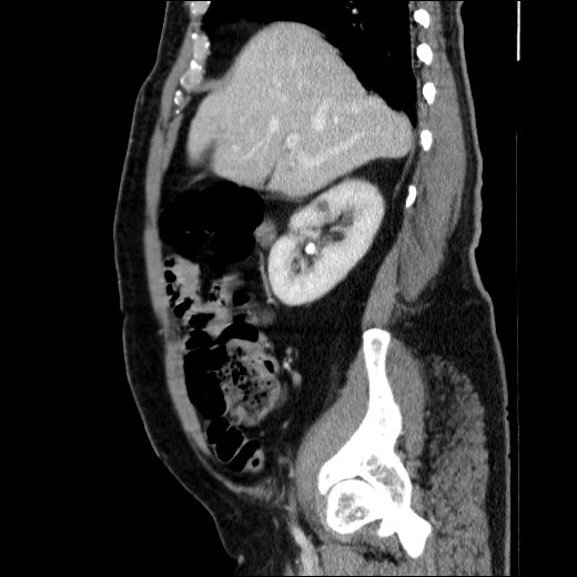 Obstructing ureteric calculus (Radiopaedia 49281-54373 C 64).jpg