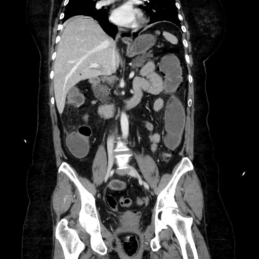 Obstructive distal colonic adenocarcinoma causing cecal perforation (Radiopaedia 86830-102989 C 103).jpg