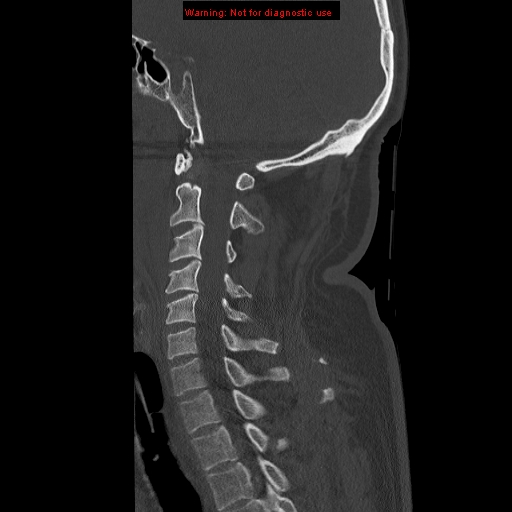 File:Occipital condyle fracture (Radiopaedia 18366-18208 Sagittal bone window 15).jpg