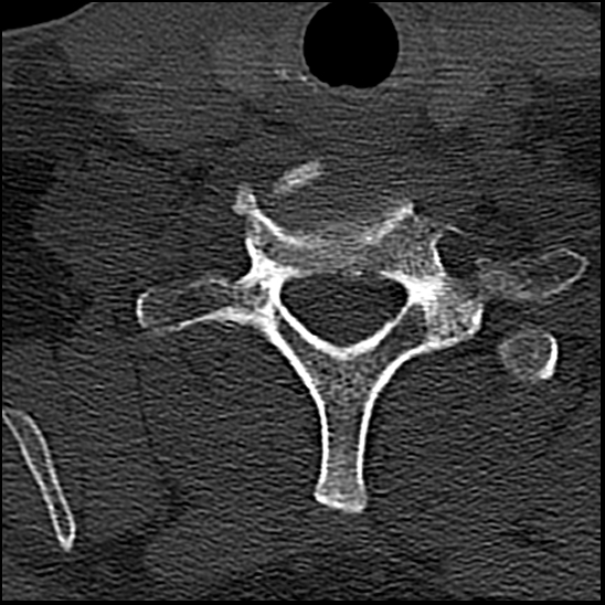 Occipital condyle fracture (type 1) (Radiopaedia 87670-104084 Axial bone window 74).jpg