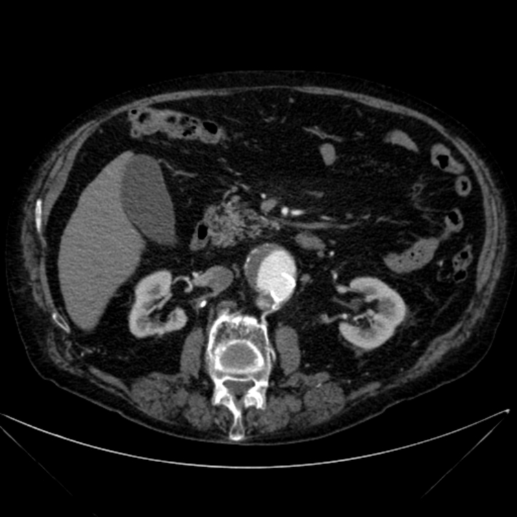 Abdominal aortic aneurysm (Radiopaedia 25855-26001 Axial C+ arterial phase 56).jpg