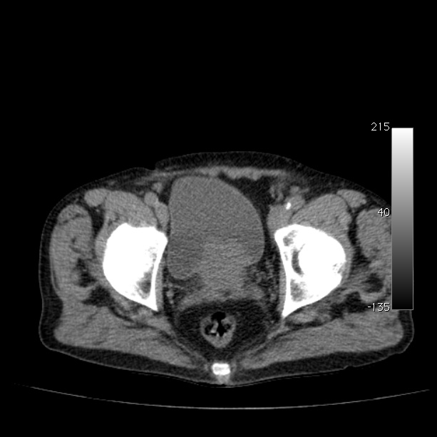 Abdominal aortic aneurysm (Radiopaedia 29248-29660 Axial non-contrast 53).jpg
