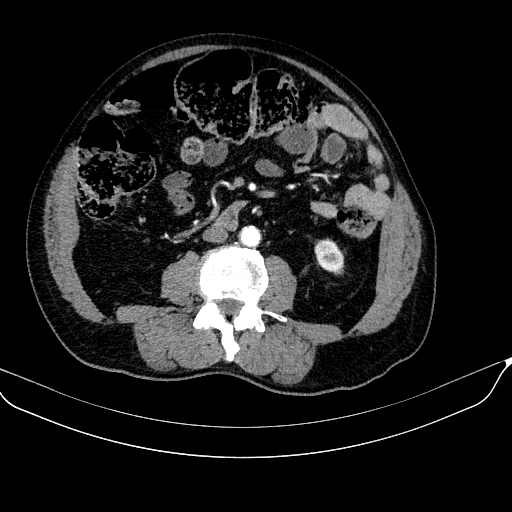 File:Abdominal aortic aneurysm (Radiopaedia 67117-76452 Axial C+ arterial phase 73).jpg