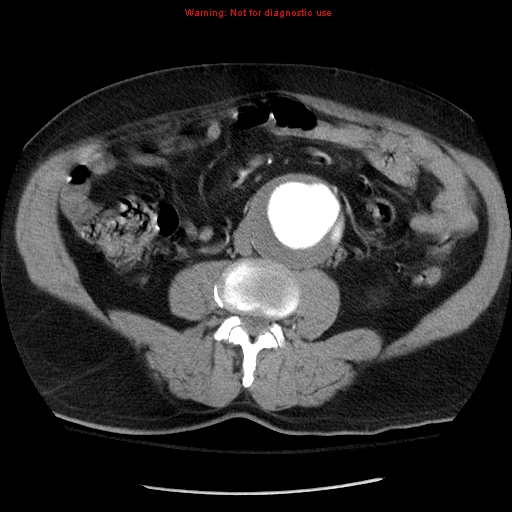 Abdominal aortic aneurysm (Radiopaedia 8190-9038 Axial C+ arterial phase 46).jpg
