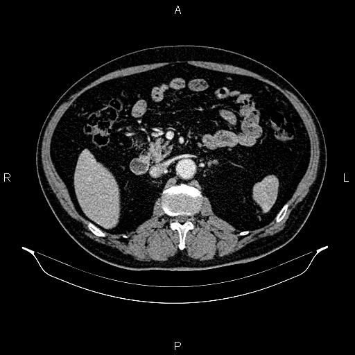 Abdominal aortic aneurysm (Radiopaedia 83094-97462 Axial renal cortical phase 89).jpg