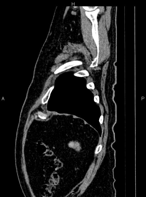 Abdominal aortic aneurysm (Radiopaedia 83094-97462 Sagittal renal cortical phase 111).jpg