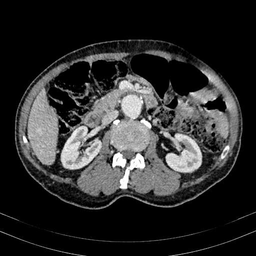 File:Abdominal aortic aneurysm (Radiopaedia 83581-98689 Axial C+ portal venous phase 49).jpg