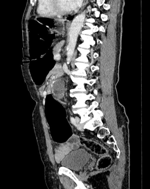 Abdominal aortic aneurysm (Radiopaedia 83581-98689 Sagittal C+ portal venous phase 66).jpg