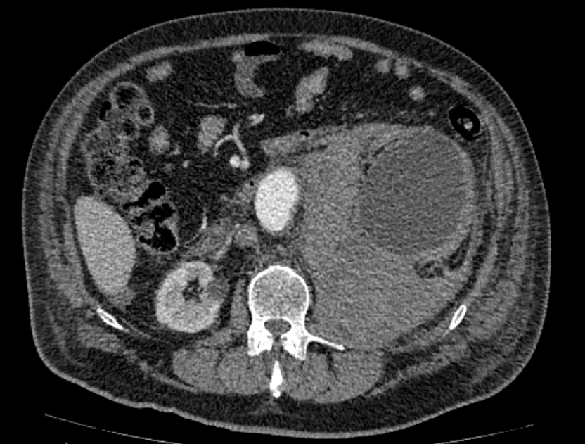 Abdominal aortic aneurysm rupture (Radiopaedia 54179-60362 Axial C+ portal venous phase 22).jpg