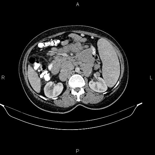 Abdominal lymphoma with sandwich sign (Radiopaedia 84378-99704 Axial C+ portal venous phase 24).jpg