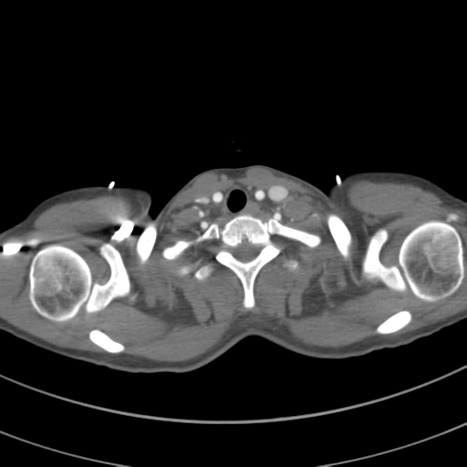 File:Abdominal multi-trauma - devascularised kidney and liver, spleen and pancreatic lacerations (Radiopaedia 34984-36486 Axial C+ arterial phase 8).png