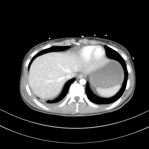 Abdominal multi-trauma - devascularised kidney and liver, spleen and pancreatic lacerations (Radiopaedia 34984-36486 Axial C+ portal venous phase 9).png