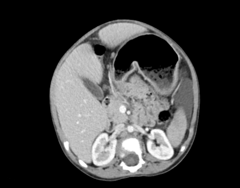 Abdominal premesenteric cystic lymphangioma (Radiopaedia 82995-97350 Axial C+ portal venous phase 22).jpg