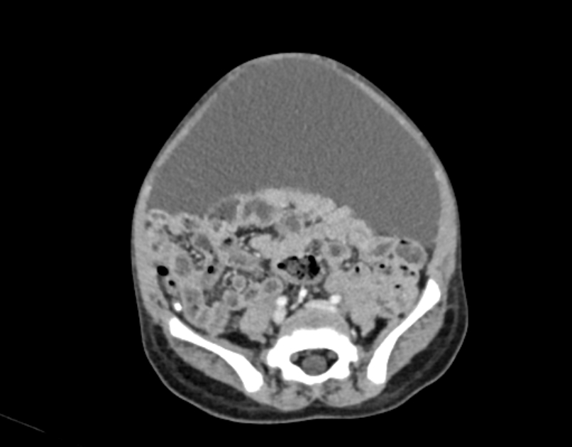 Abdominal premesenteric cystic lymphangioma (Radiopaedia 82995-97350 Axial C+ portal venous phase 45).jpg